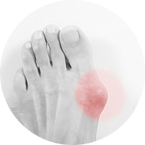 Minimially Invasive Bunion Treatment