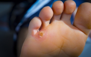 When to See a Podiatrist About Your Plantar Warts