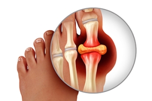 Causes of Gout and Global Occurrence
