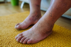 Do Not Ignore These Diabetic Foot Warning Signs