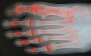 Nonsurgical Treatments for Foot and Ankle Arthritis