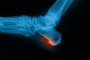 Cuboid Syndrome is a Lesser-Known Foot Condition