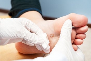 Are Plantar Warts Contagious?