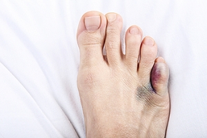 Types of Foot Bones Commonly Affected by Stress Fractures