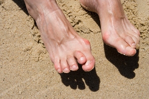 Is Hammertoe Uncomfortable?