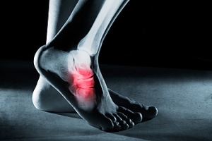 Causes and Sensations of Foot Stress Fractures