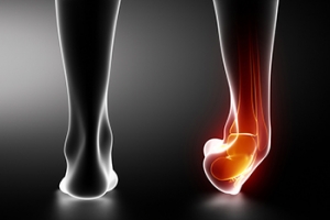 How Did I Sprain My Ankle?