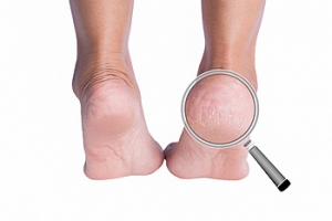 Causes Of Cracked Heels