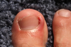 Causes of an Ingrown Toenail